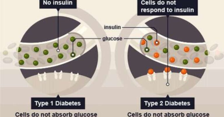Exploring the Promise of Type 2 Diabetes Stem Cell Treatment India : A Revolutionary Approach to Diabetes Management