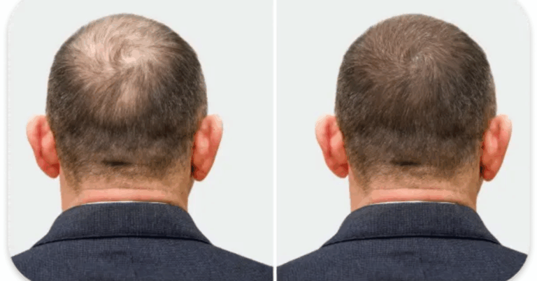 Best Hair Regrowth Treatment For Men: Complete Guide to Stronger, Healthier Hair